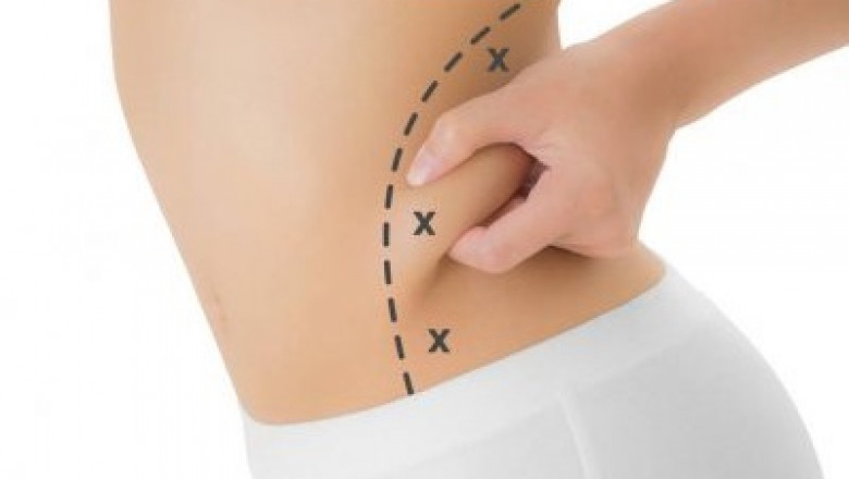 How to Choose Between Liposuction and Noninvasive Fat Reduction Procedures