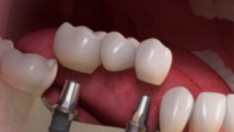 Why Do We Require Deep Teeth Cleaning?