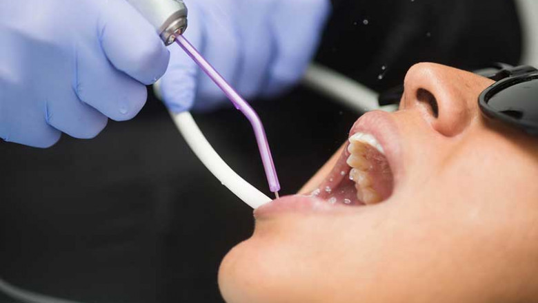 Can you explain the procedure of dental veneers?