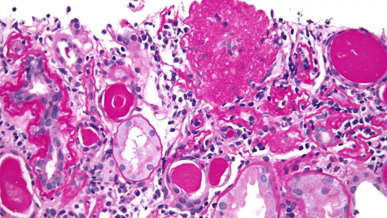 Focal Segmental Glomerulosclerosis Market: Forecasts, Share, Size, and Growth, 2022-2028