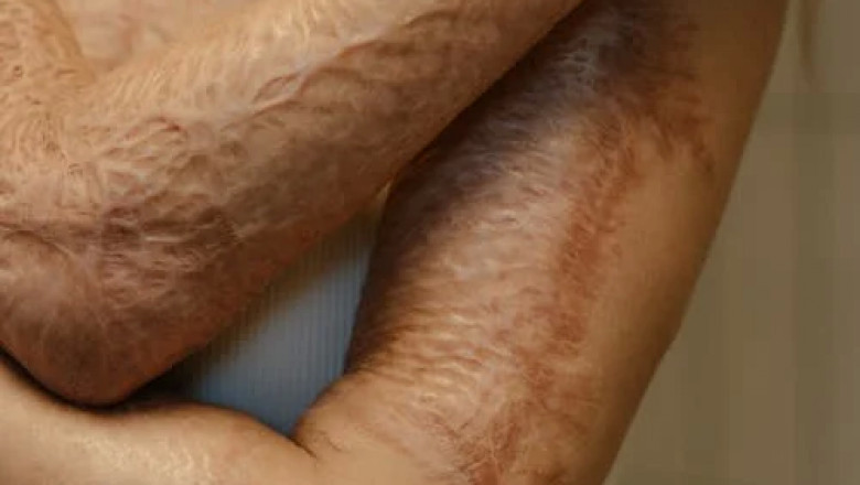 How Can Burn Injury Attorneys Help?