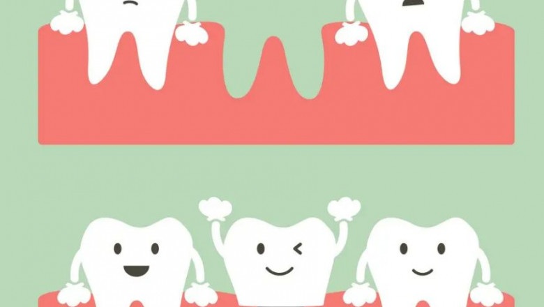 The Cost of Dental Implants - Factors That Affect the Price of the Procedure