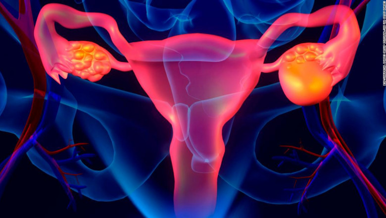 All you need to Know about Ovarian Cancer Drugs