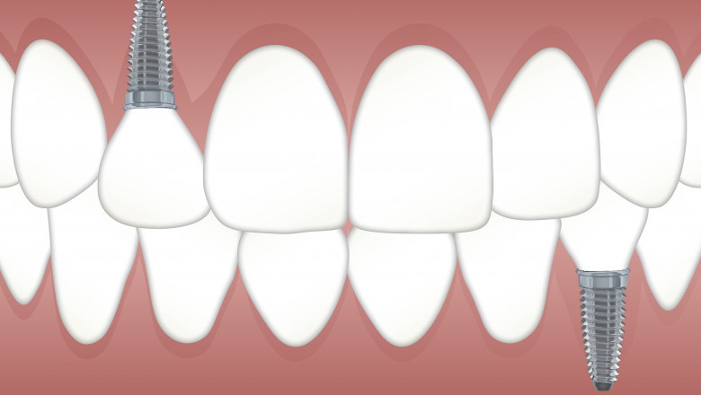 Do dental implants have a maximum age?