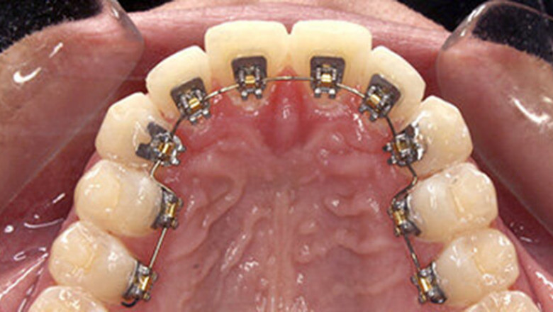 Do Lingual Braces Cause More Pain or Discomfort Than Other Braces?