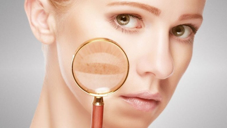 Systemic Lupus Erythematosus Treatment Market Segment Analysis