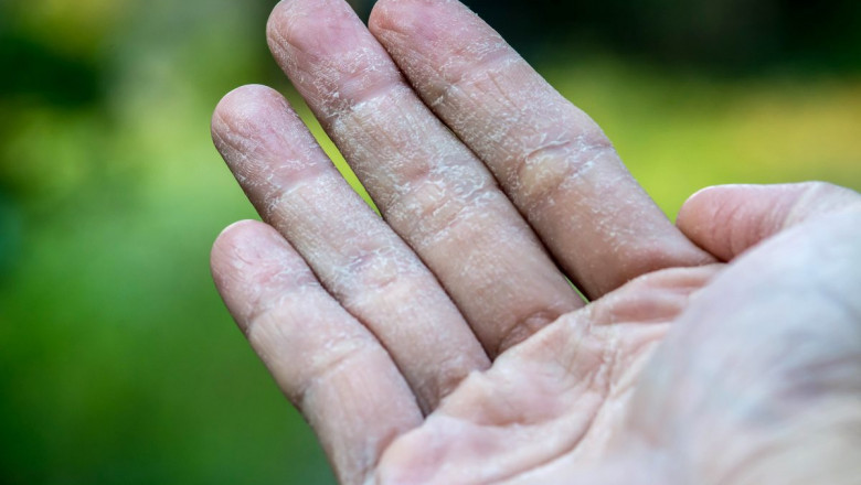 Eczema Therapeutics Market Research Report Detailed Analysis 2022| Research Informatic