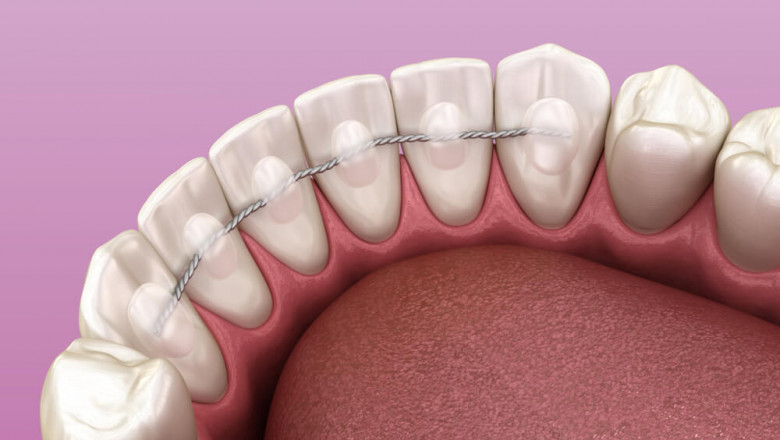 How Long Do We Have To Wear Permanent Retainers?