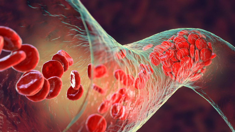 Venous Thromboembolism (VTE) Market Scope, Size, Implementation, Analytical Overview, Forecast 2030