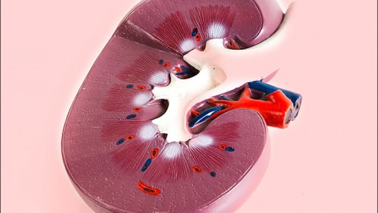 Glomerulosclerosis, also known as Focal Segmental Glomerulosclerosis, is a disorder in which scar tissue develops on the kidney's glomeruli, which filter waste products