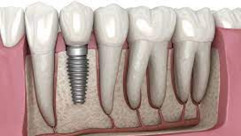 What Is The Use Of Dental Implants, And Why Are They Important?