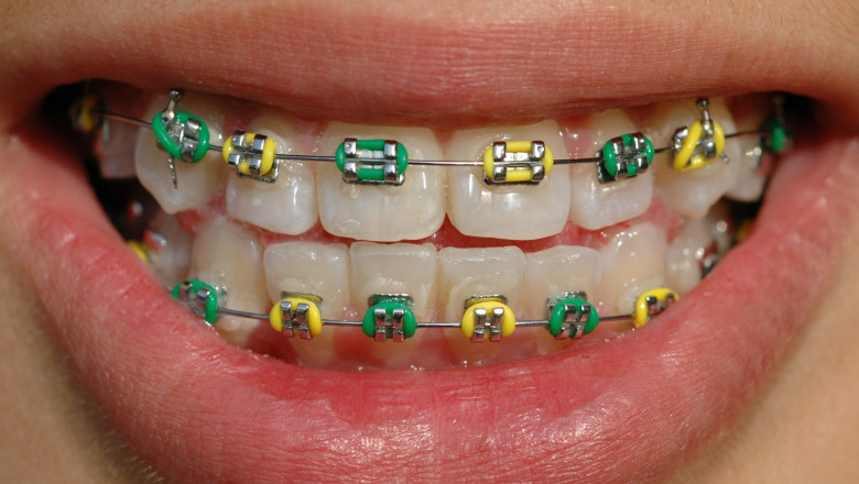 The Perfect Braces Color For Your Teeth