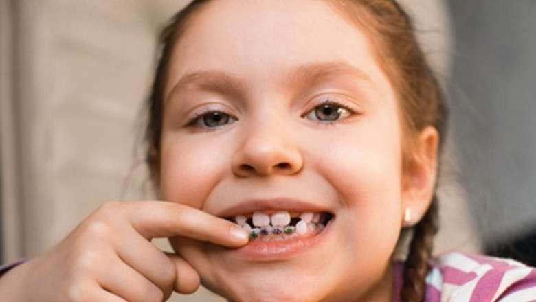 Is It Possible To Get Dental Braces With Missing Teeth?