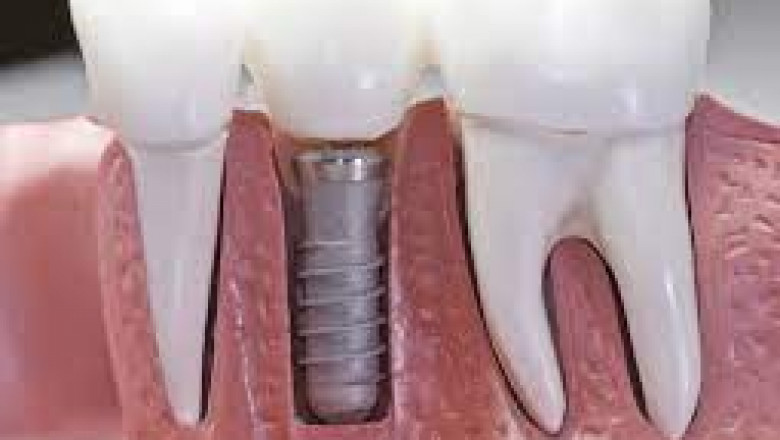 What Are The Two Effective Types Of Dentures?