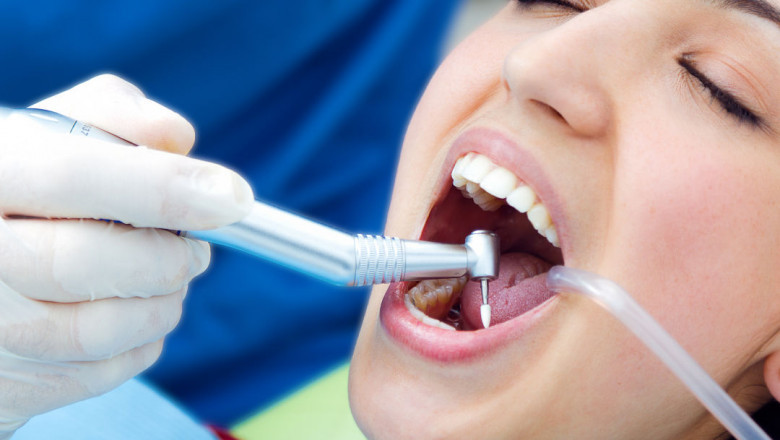 Is It Necessary to Go to the Dentist for Deep Cleaning?