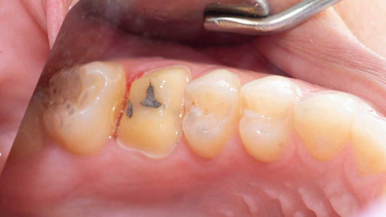 What Are The Benefits Of Getting Lumineers?