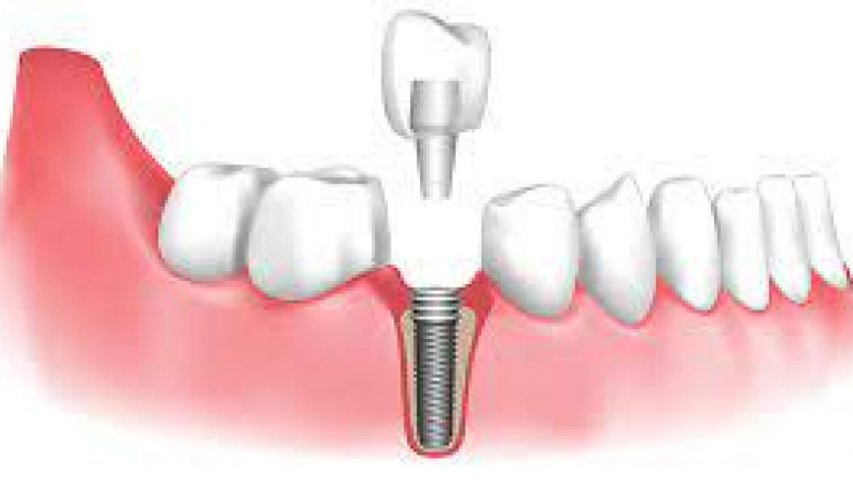 What Are The Significant Advantages Of Getting Dental Implants?