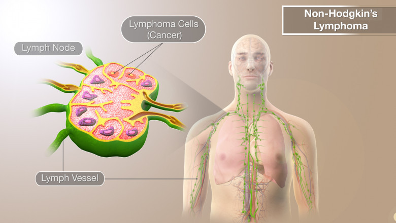 What are the Therapies involved in Non-Hodgkins Lymphoma Treatment?
