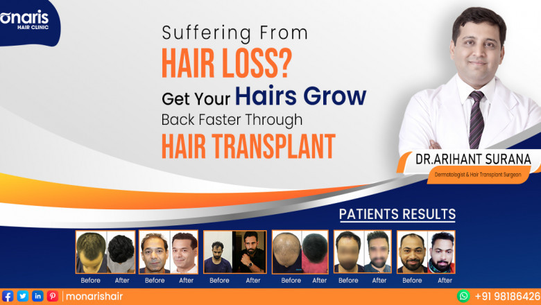 Hair Transplant in Indore - Monaris Hair Clinic