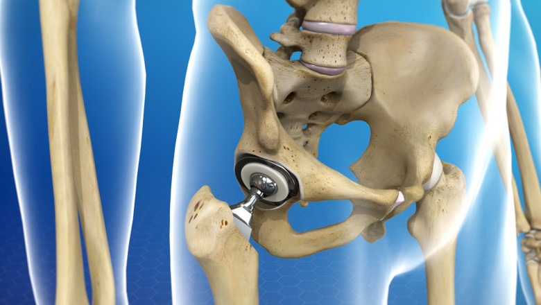 Increasing Per Capita Health-Care Spending Will Accelerate The Growth Rate Of The Hip Replacement Market In The Future