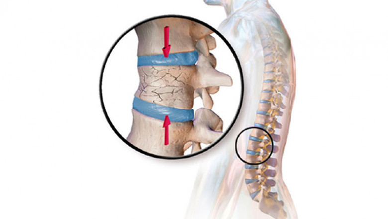 The Growth Of The Vertebral Compression Fracture Devices Market Is Expected To Be Hampered By Vertebral Posterior Element Fracture And Stringent Regulatory Approval Procedures