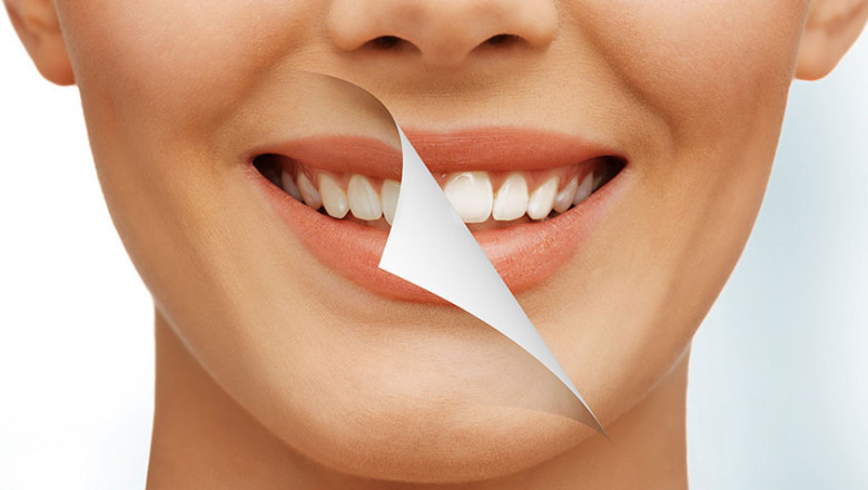 Why should you whiten your teeth?