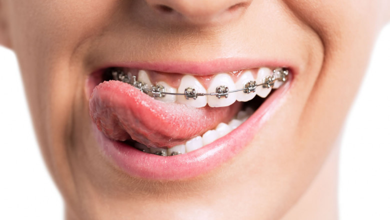 How To Fix An Underbite With The Help Of Braces?