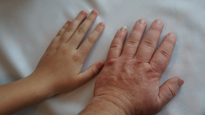 New Acromegaly Treatments Are Becoming Available With Increased Research and Development Activities