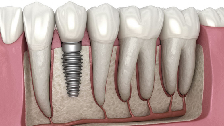 What Are the Common Invisalign Faqs?