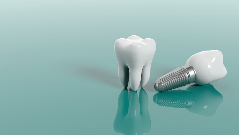 What is All-on-4 Dental Implant Procedure?