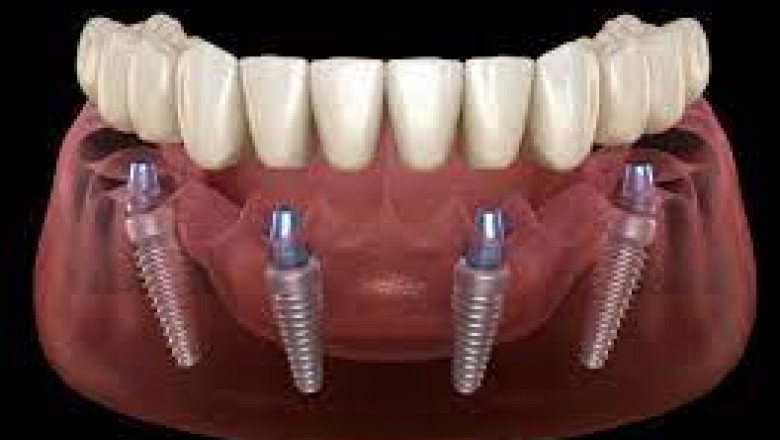 What May New Dentures Feel Like?