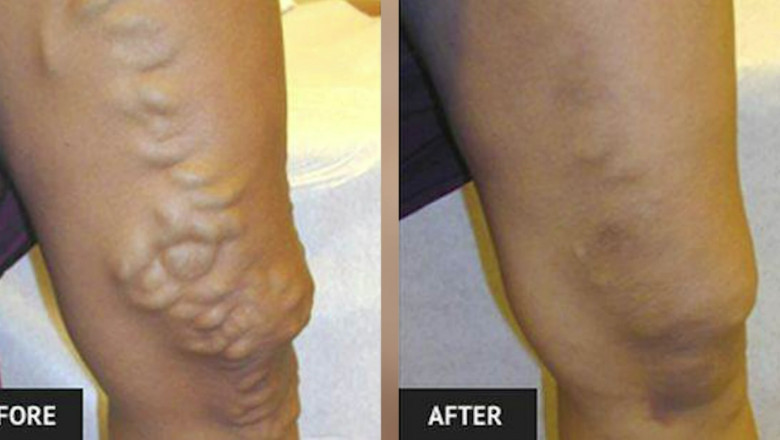 What Risk Factors Associates With Varicose Veins?
