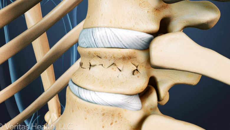 Vertebral Compression Fracture Devices Involve Injecting Cement into the Fractured Area to Stabilize the Broken Bone
