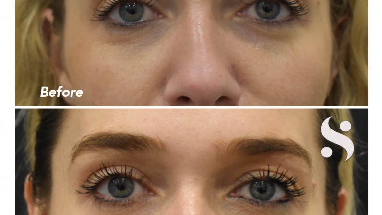 Tear Trough Dermal Filler - Serenity Athletics