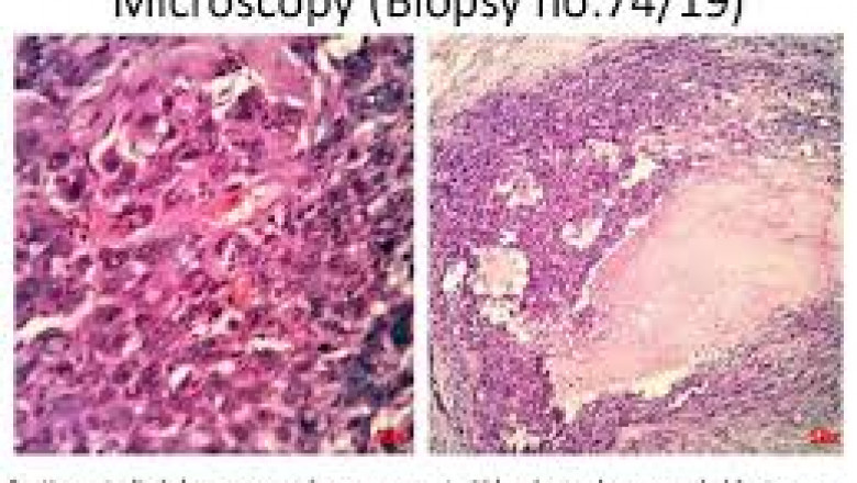Sarcoma Biopsy Market Size, Share, Regional Overview and Global Forecast to 2028