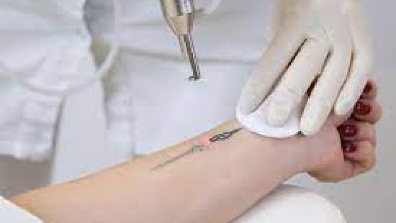 Tattoo Removal Lasers Market Size, Key Players Analysis And Forecast To 2028 | Value Market Research