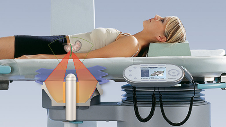 Chile Extracorporeal Shock Wave Market: Share, Size, CAGR, Growth, Analysis, Worth, Trends, Scope, Impact & Forecast till 2027