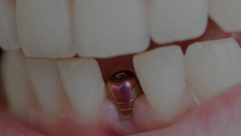 What Exactly Are Same Day Dentures?