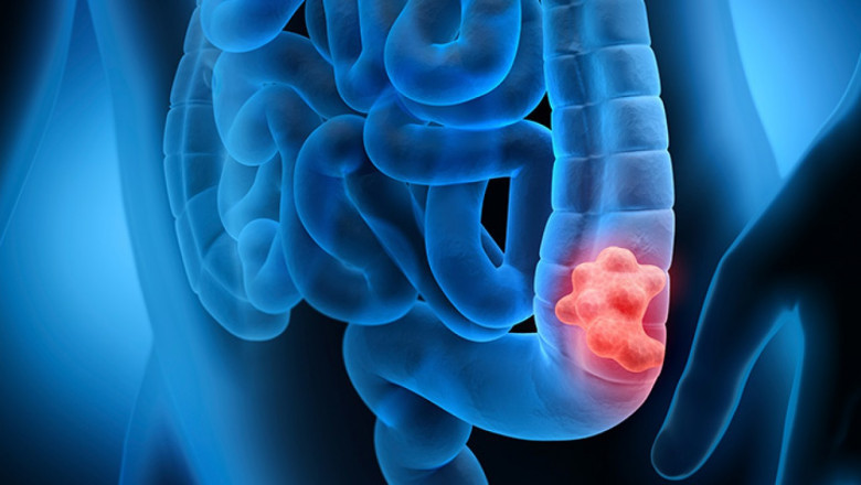 Colorectal Cancer Screening Including Surgery, Radiotherapy, And Medication Treatments Such Chemotherapy