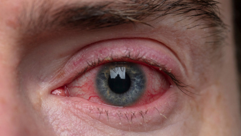 GET RID OF RED EYES WITHOUT EYE DROPS