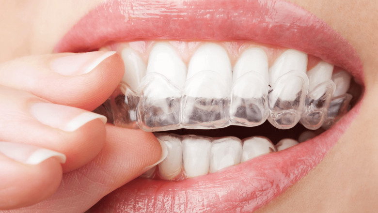 What is Orthodontic Braces Treatment Procedure?