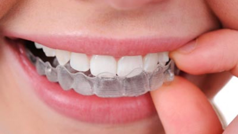 What Can I Do If I Can't Get A Root Canal?