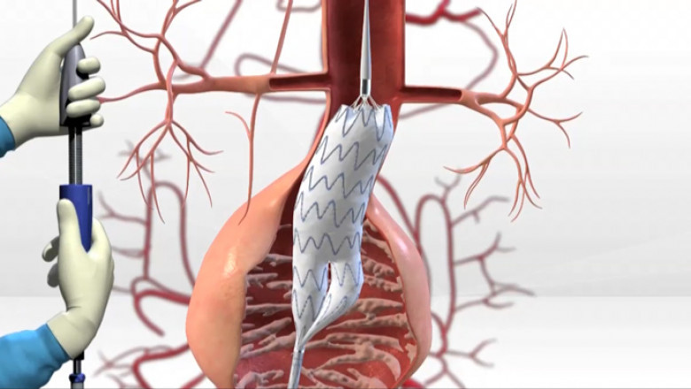 A minimally invasive procedure called Endovascular Aneurysm Repair (EVAR) can be used to treat abdominal aortic aneurysms.