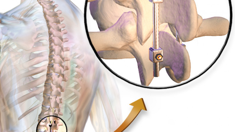 An artificial spine that does not fuse is called a Spinal Non-Fusion Device, and it is used by surgeons to treat spinal deformities, stabilize and strengthen the spine, and encourage fusion.