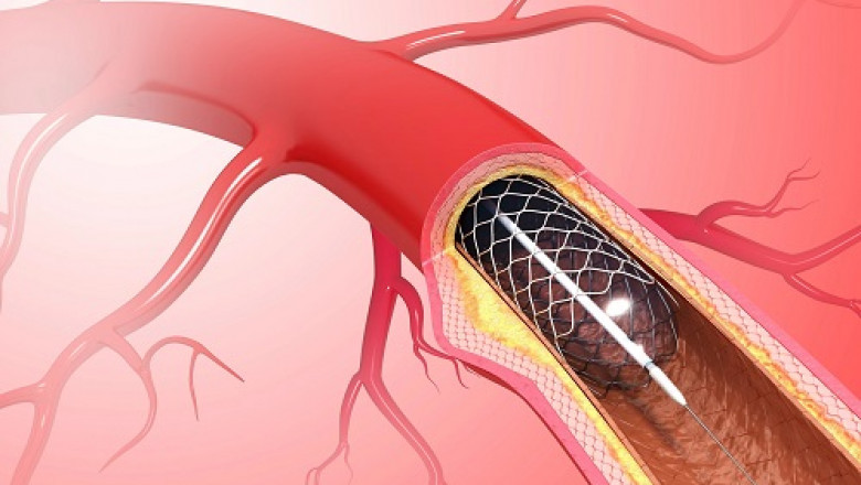 Plaque and thrombus are easily removed from damaged arteries by atherectomy devices