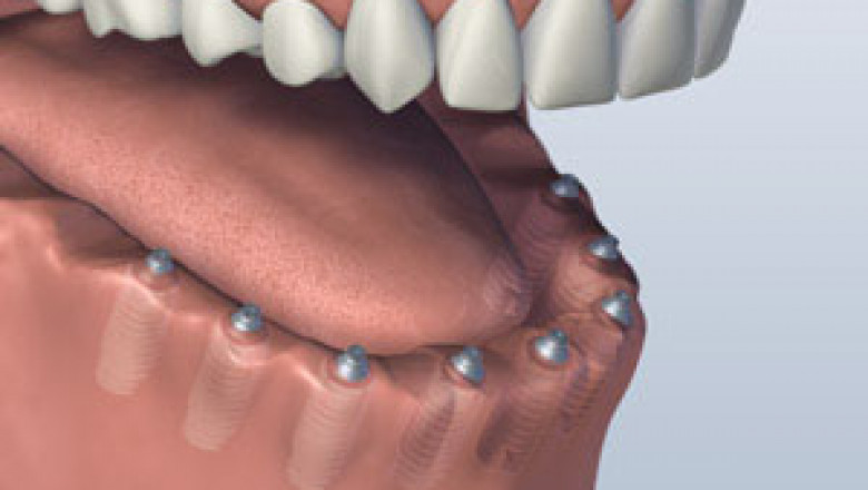 Why you ought to research dental inserts