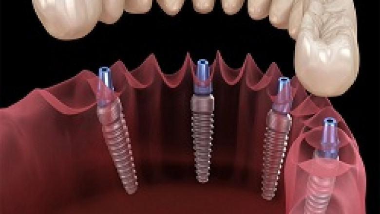 How Would You Define Dental Implants?