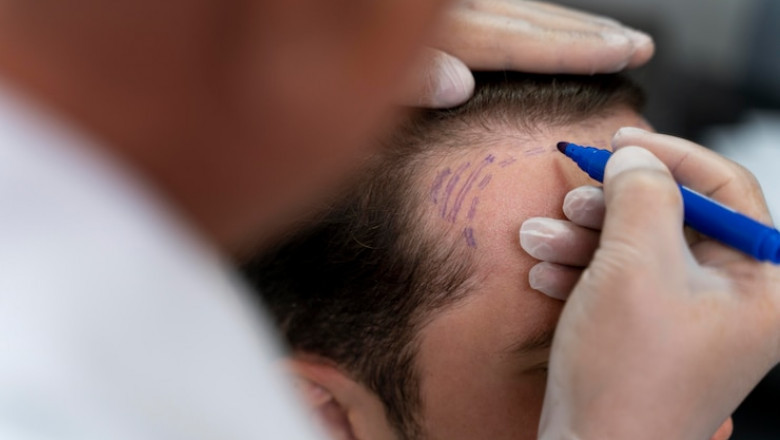 What to avoid after a hair transplant for the best result