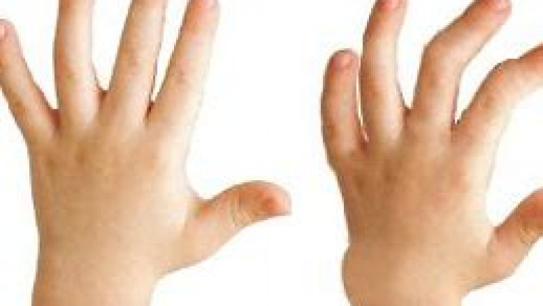 Hunter Syndrome Treatment Market 2022 Size, Future Demand, Global Research Report To 2028