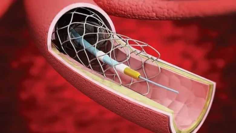 Statistical analysis of the global non-vascular stents market: trends, share, size, growth, opportunity, and forecast, 2025